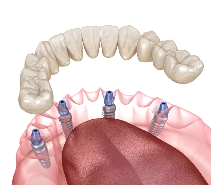 All-on-4 au cabinet dentaire Mirabeau Paris 16