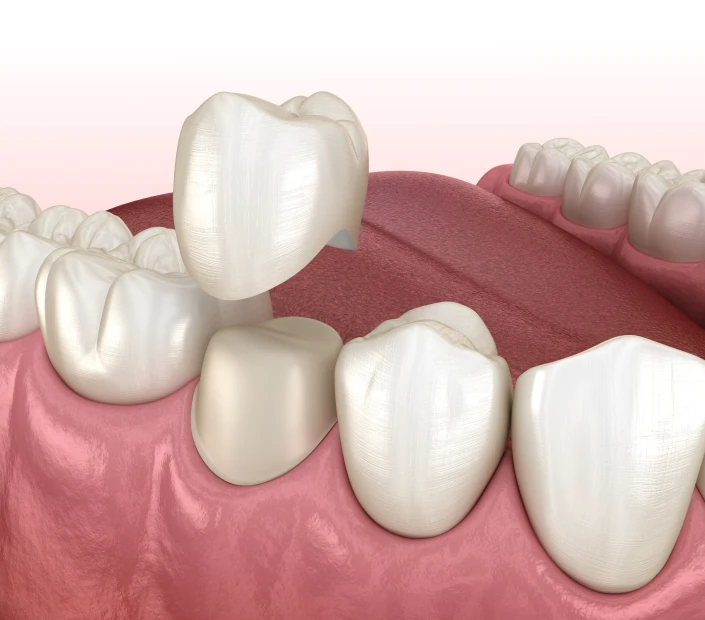 Couronnes ceramiques au cabinet dentaire Mirabeau à Paris 16