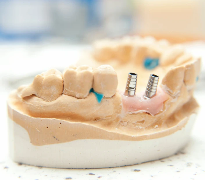 Greffe osseuse au cabinet dentaire Mirabeau à Paris 16