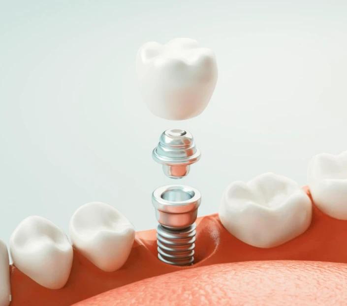 Implant dentaire au cabinet dentaire Mirabeau Paris 16