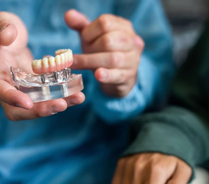 Prothèse sur implant au cabinet dentaire Mirabeau Paris 16